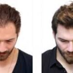 Hair transplant in Dubai (2)