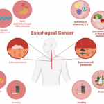 esophageal cancer singapore