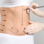 liposuction in Islamabad